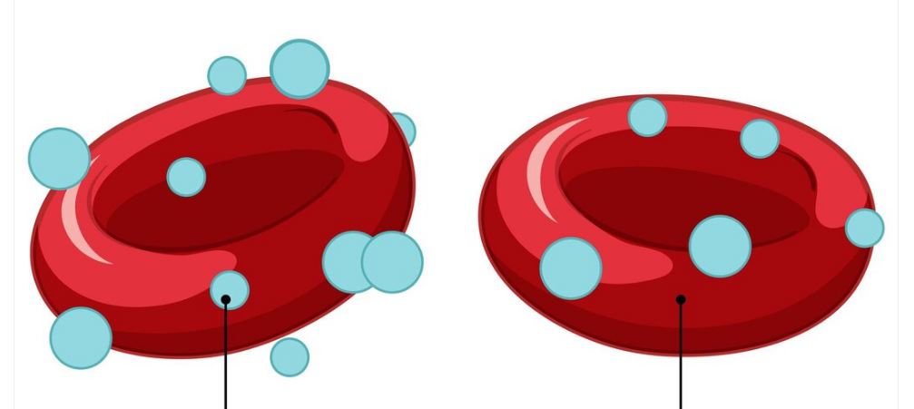 Types of sickle cell disease