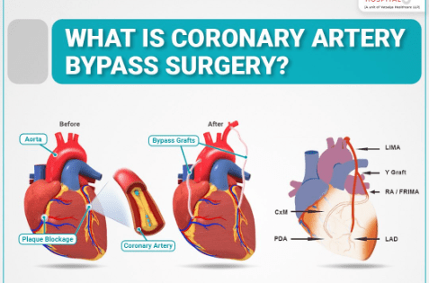 Bypass Surgery Bypass Surgery